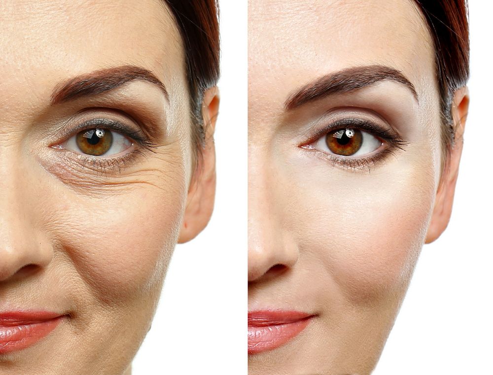 Behandlungsresultat-mit-Anti-Aging-Creme-nach-3-Monaten