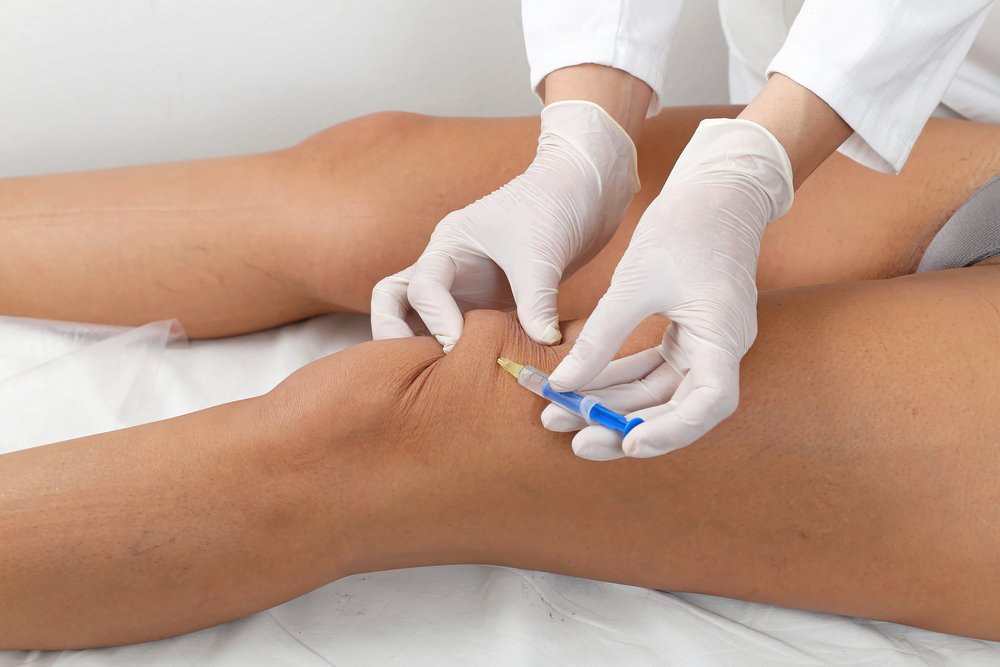 Hyaluron-Injektion ins Knie bei Arthrose